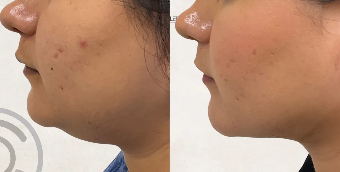 SmoothLipo